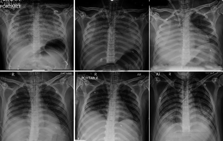 Extracorporeal Membrane Oxygenation in Severe Pulmonary Forms of Leptospirosis: A Report of Two Cases.