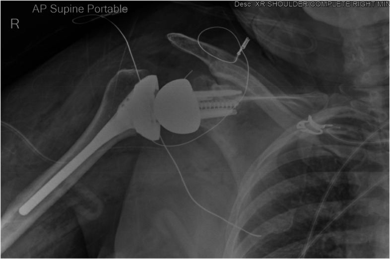 Iatrogenic Injury to the Suprascapular Nerve Following Reverse Shoulder Arthroplasty: A Case Report.