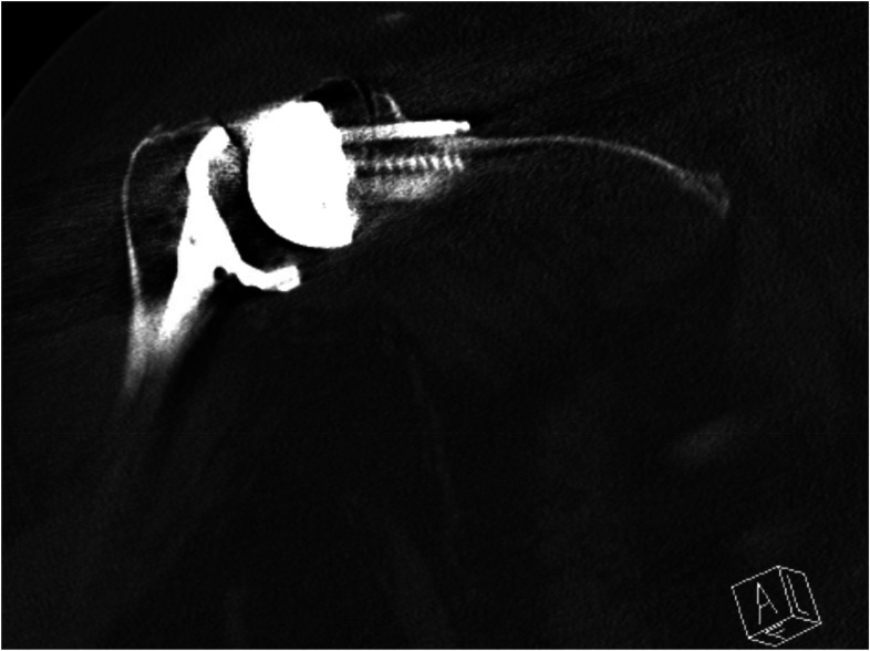 Iatrogenic Injury to the Suprascapular Nerve Following Reverse Shoulder Arthroplasty: A Case Report.