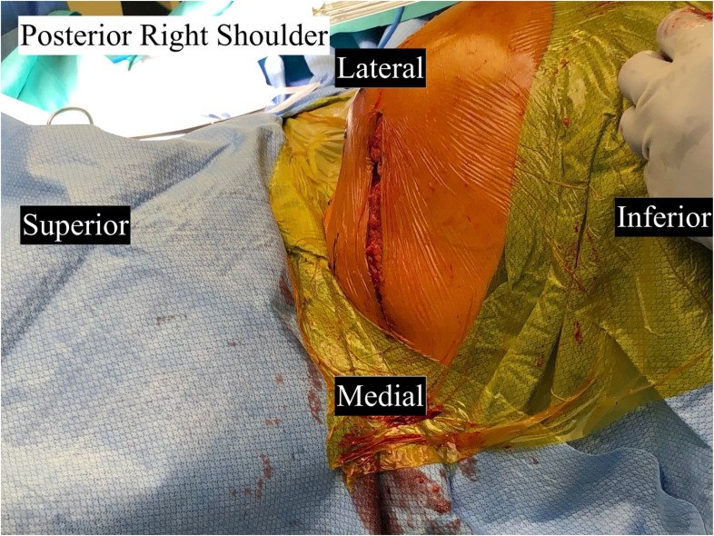 Iatrogenic Injury to the Suprascapular Nerve Following Reverse Shoulder Arthroplasty: A Case Report.