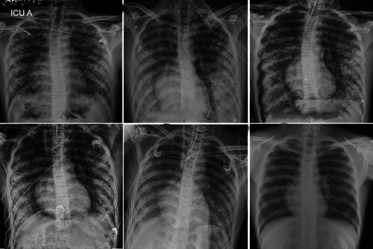 Extracorporeal Membrane Oxygenation in Severe Pulmonary Forms of Leptospirosis: A Report of Two Cases.