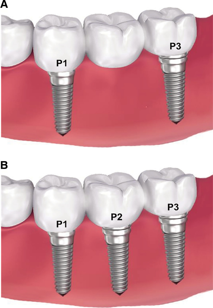 A retrospective comparison of clinical outcomes of implant restorations for posterior edentulous area: 3-unit bridge supported by 2 implants vs 3 splinted implant-supported crowns.