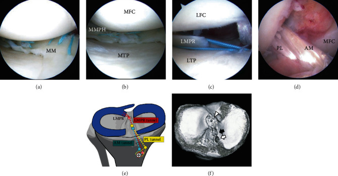 Transtibial Pullout Repair of Lateral Meniscus Posterior Root Tear with Tissue Loss: A Case with Anterior Cruciate Ligament Injury and Medial Meniscus Tear.
