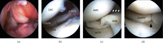 Transtibial Pullout Repair of Lateral Meniscus Posterior Root Tear with Tissue Loss: A Case with Anterior Cruciate Ligament Injury and Medial Meniscus Tear.