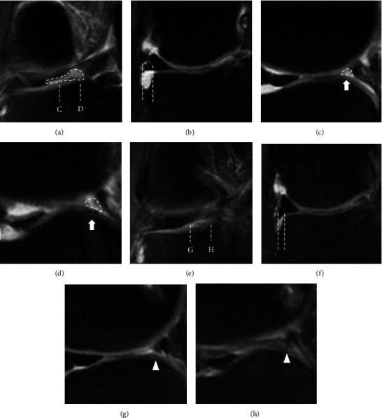 Transtibial Pullout Repair of Lateral Meniscus Posterior Root Tear with Tissue Loss: A Case with Anterior Cruciate Ligament Injury and Medial Meniscus Tear.
