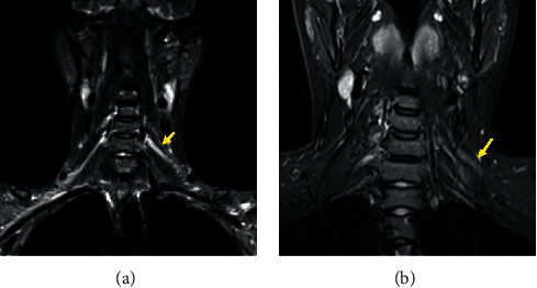 Neuropathic Pain Relief after Surgical Neurolysis in Patients with Traumatic Brachial Plexus Injuries: A Preliminary Report.