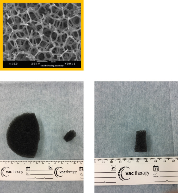 Usefulness of vacuum-assisted closure after stoma closure with purse string suturing: a retrospective trial.