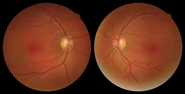 Clinical Reasoning: Wilbrand's Knee, Scotoma of Traquair, and Normal Tension Glaucoma.