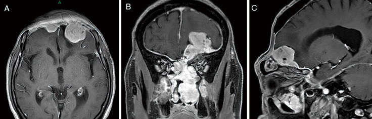 Efficacy of a High-definition Three-dimensional Exoscope in Simultaneous Transcranial and Endoscopic Endonasal Surgery: A Case Report.