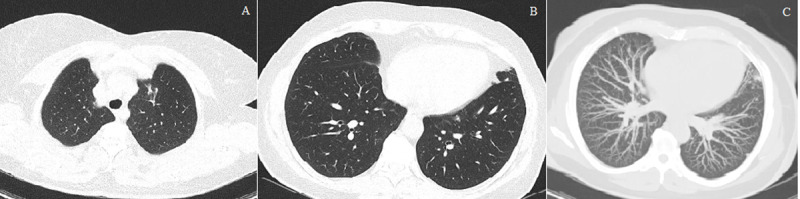 COVID-19 Pneumonia Presenting with Multiple Nodules Mimicking Metastases: An Atypical Case.