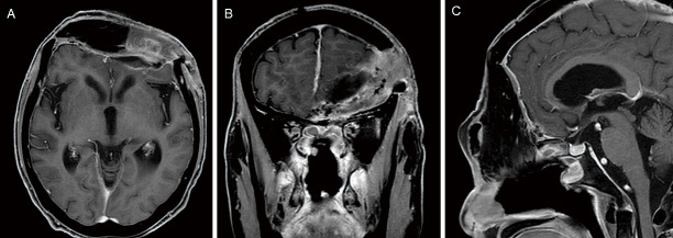 Efficacy of a High-definition Three-dimensional Exoscope in Simultaneous Transcranial and Endoscopic Endonasal Surgery: A Case Report.