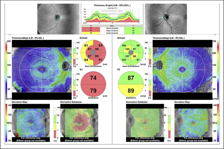 Clinical Reasoning: Wilbrand's Knee, Scotoma of Traquair, and Normal Tension Glaucoma.