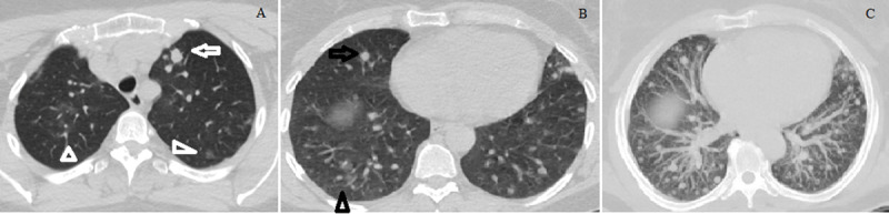 COVID-19 Pneumonia Presenting with Multiple Nodules Mimicking Metastases: An Atypical Case.