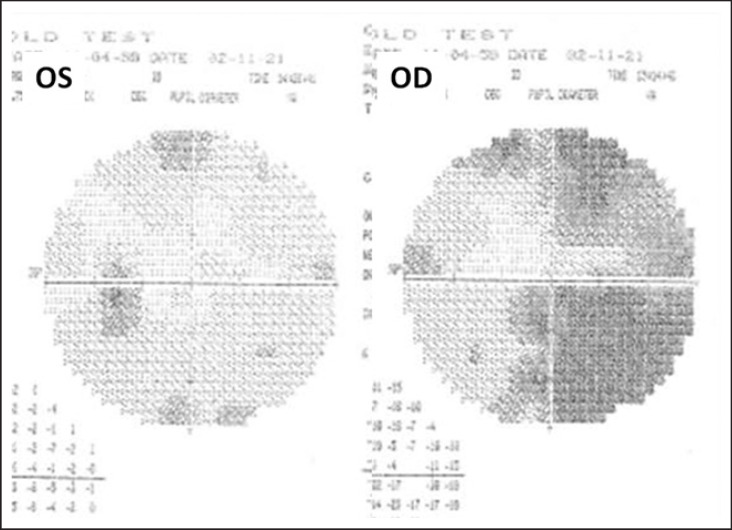 Clinical Reasoning: Wilbrand's Knee, Scotoma of Traquair, and Normal Tension Glaucoma.