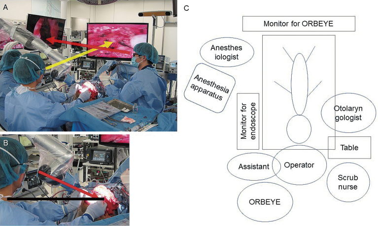 Efficacy of a High-definition Three-dimensional Exoscope in Simultaneous Transcranial and Endoscopic Endonasal Surgery: A Case Report.