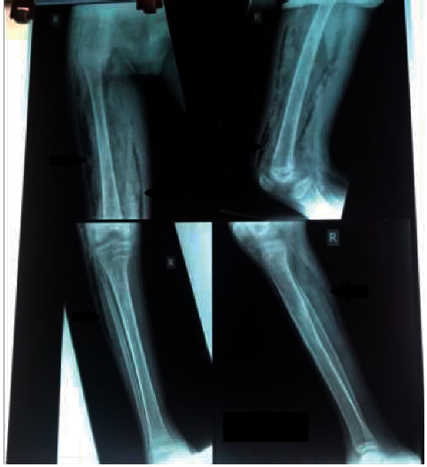 An Unusual Cause of Necrotising Fasciitis in a Young Male with Juvenile Dermatomyositis.