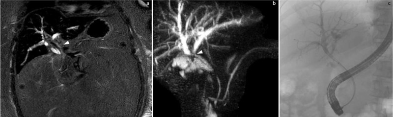 Splenic Injury Following Endoscopic Retrograde Cholangiopancreatography - A Role for Angioembolization.