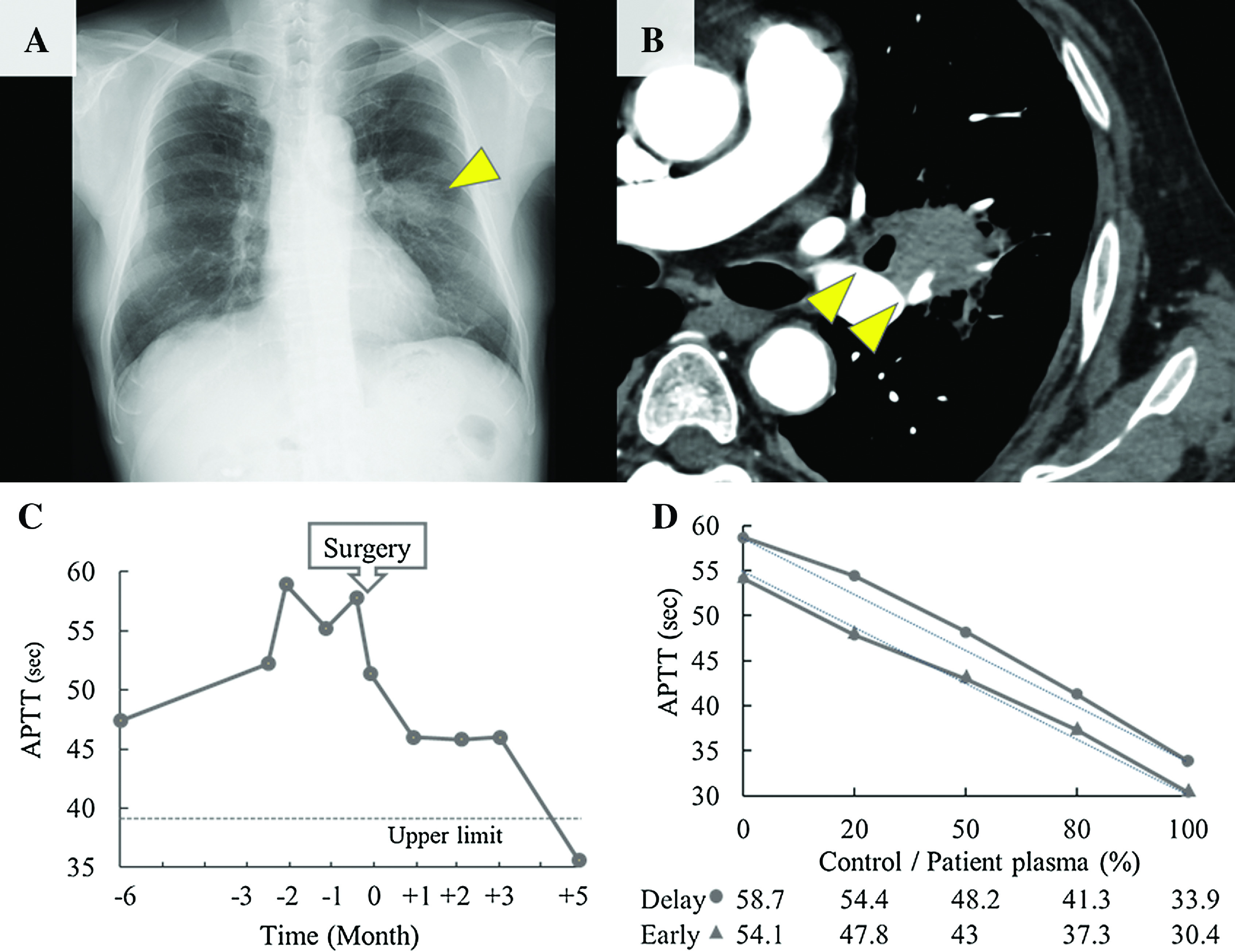 Perioperative Bypassing Agent Therapy for Pulmonary Pleomorphic Carcinoma with Acquired Hemophilia.