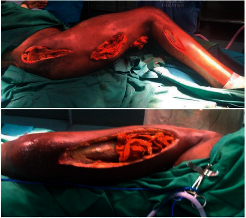 An Unusual Cause of Necrotising Fasciitis in a Young Male with Juvenile Dermatomyositis.