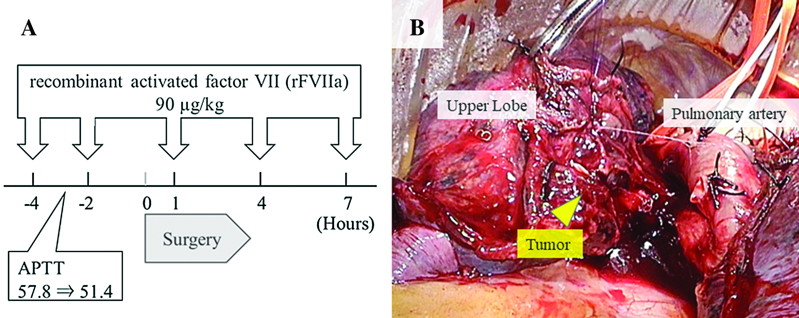 Perioperative Bypassing Agent Therapy for Pulmonary Pleomorphic Carcinoma with Acquired Hemophilia.