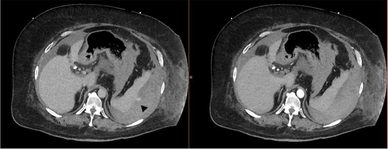 Splenic Injury Following Endoscopic Retrograde Cholangiopancreatography - A Role for Angioembolization.