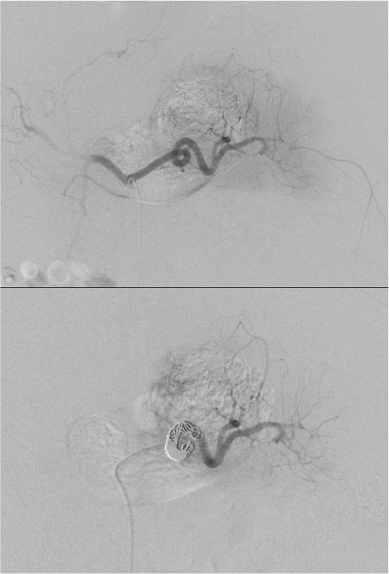 Splenic Injury Following Endoscopic Retrograde Cholangiopancreatography - A Role for Angioembolization.