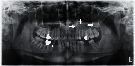 Evaluation of Mucous Retention Cyst Prevalence on Digital Panoramic Radiographs in the Local Population of Iran.