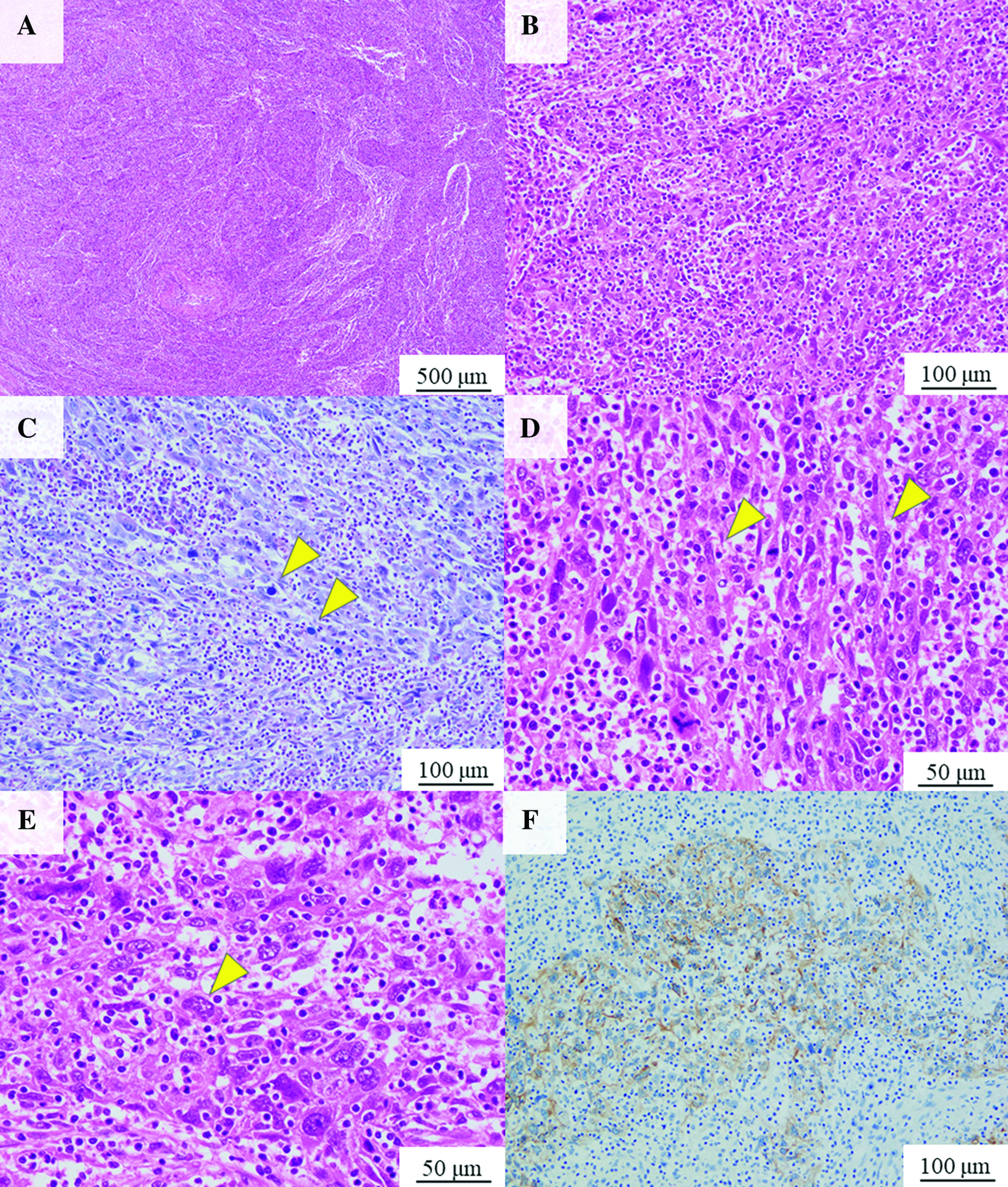 Perioperative Bypassing Agent Therapy for Pulmonary Pleomorphic Carcinoma with Acquired Hemophilia.