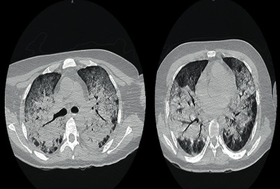 Disseminated Histoplasmosis, Pulmonary Tuberculosis, and Cytomegalovirus Disease in a Renal Transplant Recipient after Infection with SARS-CoV-2.
