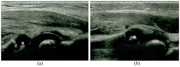 Ultrasound imaging in diagnostics of Monteggia lesion in children.