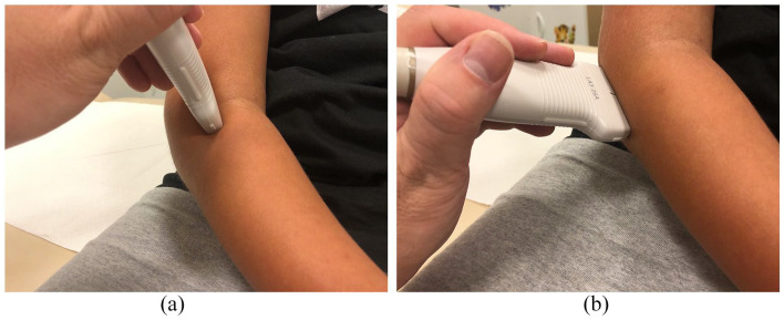 Ultrasound imaging in diagnostics of Monteggia lesion in children.