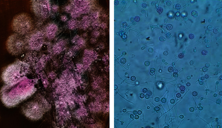 Disseminated Histoplasmosis, Pulmonary Tuberculosis, and Cytomegalovirus Disease in a Renal Transplant Recipient after Infection with SARS-CoV-2.