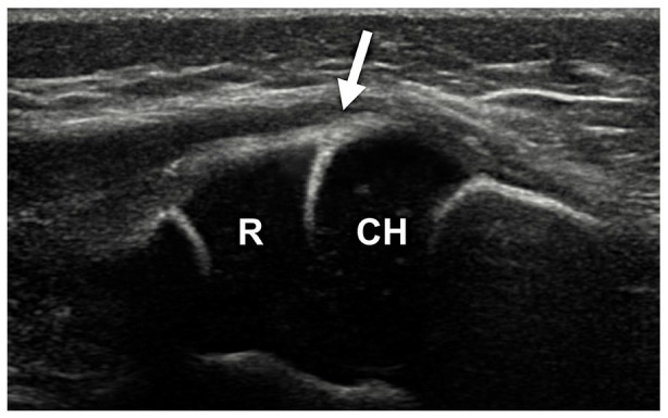 Ultrasound imaging in diagnostics of Monteggia lesion in children.
