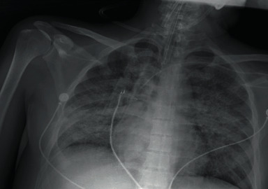 Disseminated Histoplasmosis, Pulmonary Tuberculosis, and Cytomegalovirus Disease in a Renal Transplant Recipient after Infection with SARS-CoV-2.