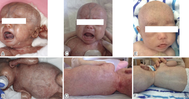 Successful hematopoietic stem cell transplantation with reduced dose of busulfan for Omenn syndrome.