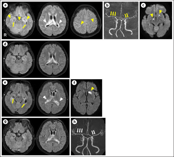 Neurosarcoidosis Presenting with Prominent Periventricular White-Matter Lesions during Steroid Treatment for Autoimmune Hepatitis.