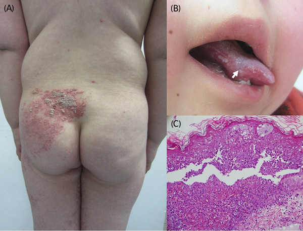 Disseminated herpes zoster with mucosal involvement in an immunosuppressed child.