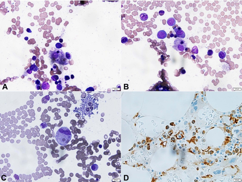 Herpes simplex virus-1 triggered hemophagocytic lymphohistiocytosis in a patient with granulomatosis with polyangiitis.