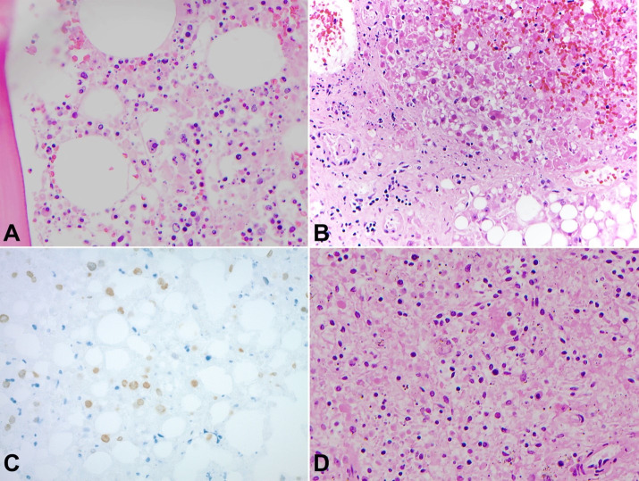 Herpes simplex virus-1 triggered hemophagocytic lymphohistiocytosis in a patient with granulomatosis with polyangiitis.