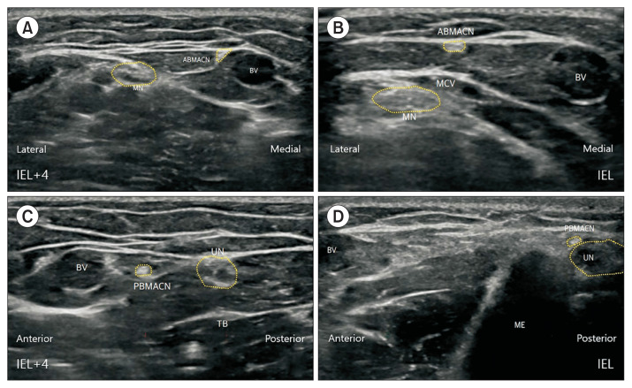 Ultrasonographic Identification of the High-Risk Zone for Medial Antebrachial Cutaneous Nerve Injury in the Elbow.