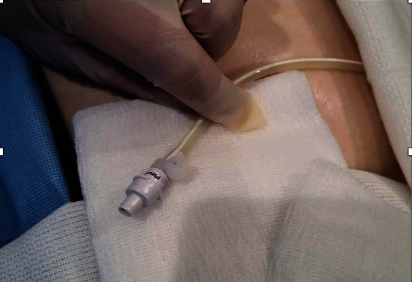 Noninvasive Management of Fractured Indwelling Tunneled Pleural Catheter Valve.