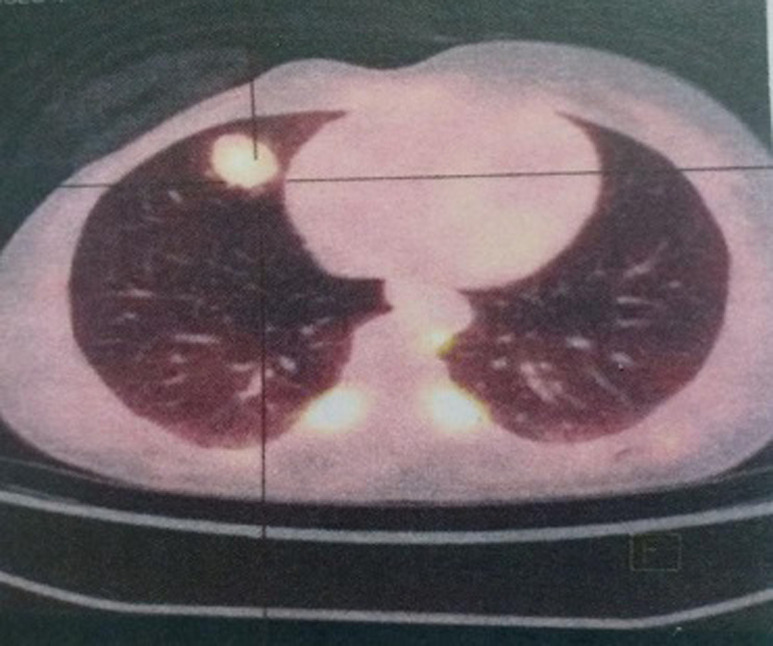 [Which chemotherapy regimen in patients with metastatic phyllodes tumors of the breast? case report].