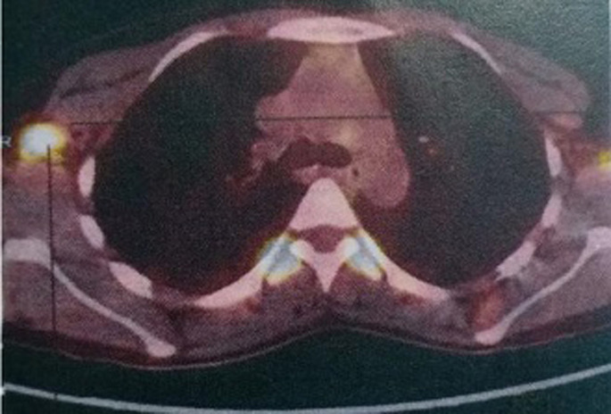 [Which chemotherapy regimen in patients with metastatic phyllodes tumors of the breast? case report].