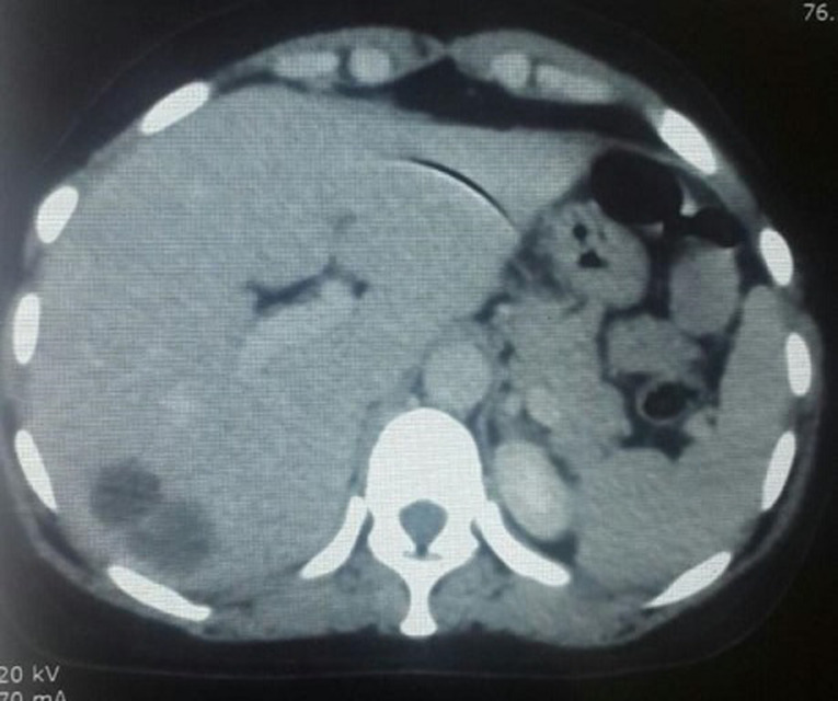 [Which chemotherapy regimen in patients with metastatic phyllodes tumors of the breast? case report].