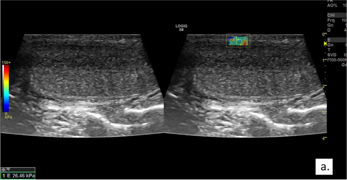 Use of penile shear wave elastosonography for the diagnosis of Peyronie's Disease: a prospective case-control study.