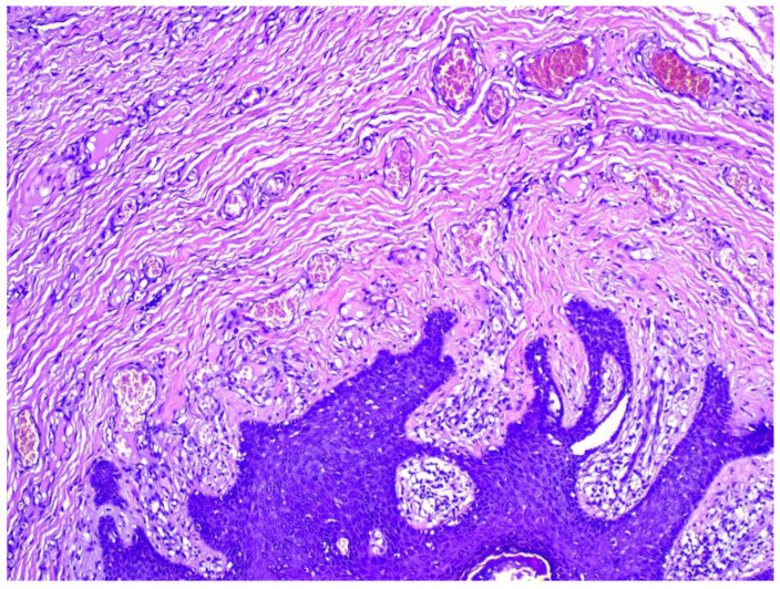 Genital Folliculosebaceous Cystic Hamartoma: A Case Report and Concise Review of the Literature.