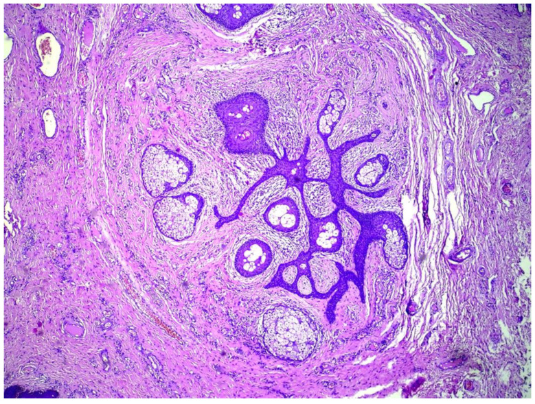 Genital Folliculosebaceous Cystic Hamartoma: A Case Report and Concise Review of the Literature.
