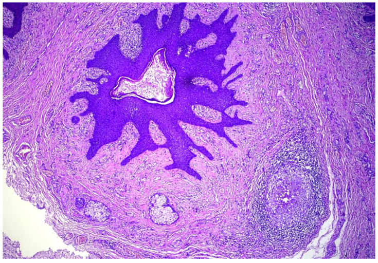 Genital Folliculosebaceous Cystic Hamartoma: A Case Report and Concise Review of the Literature.
