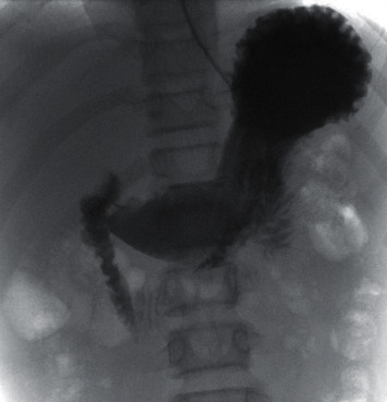 Gastric Xylobezoar Treated with Continuous Enteral Coca-Cola® Infusion.