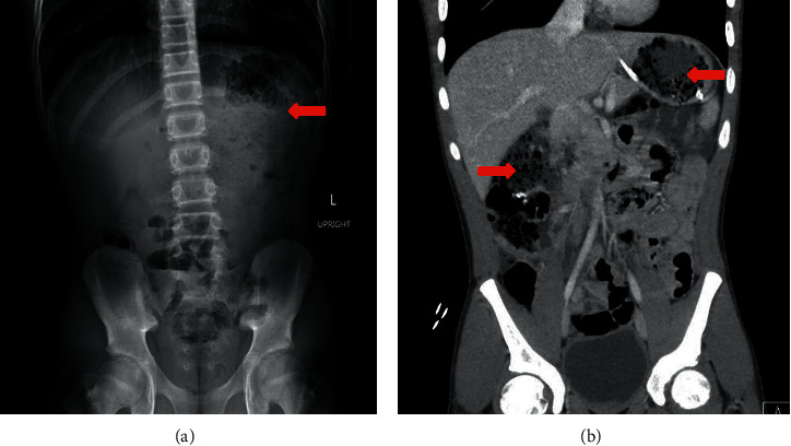Gastric Xylobezoar Treated with Continuous Enteral Coca-Cola® Infusion.